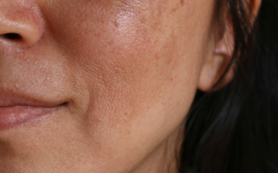 what can you do about dark spots on your skin?