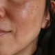 what can you do about dark spots on your skin?