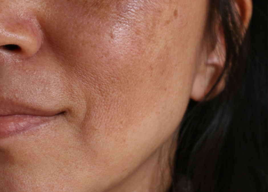 hyperpigmentation dark spots on skin anti aging antioxidants skin care